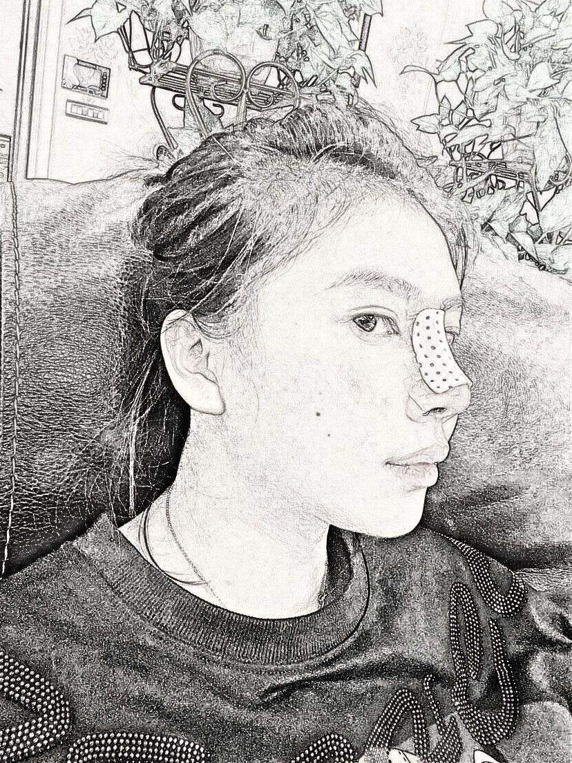 肋软骨隆鼻果怎么样？俊泰丽格医疗美容介绍