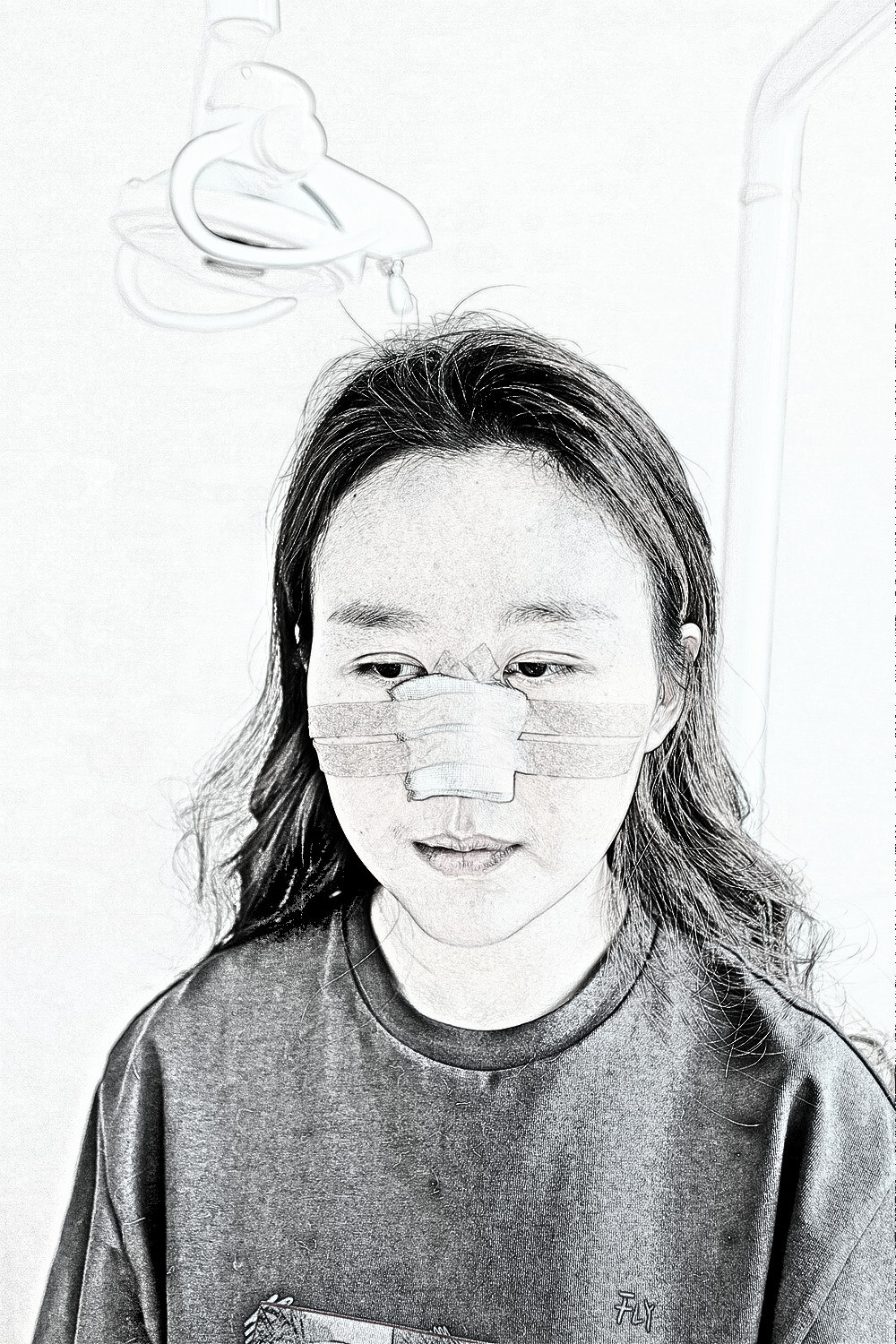 沈阳杏林整形外科医生朱石江膨体隆鼻介绍分享