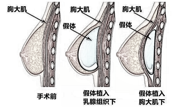 隆胸有哪些方式你都清楚吗？