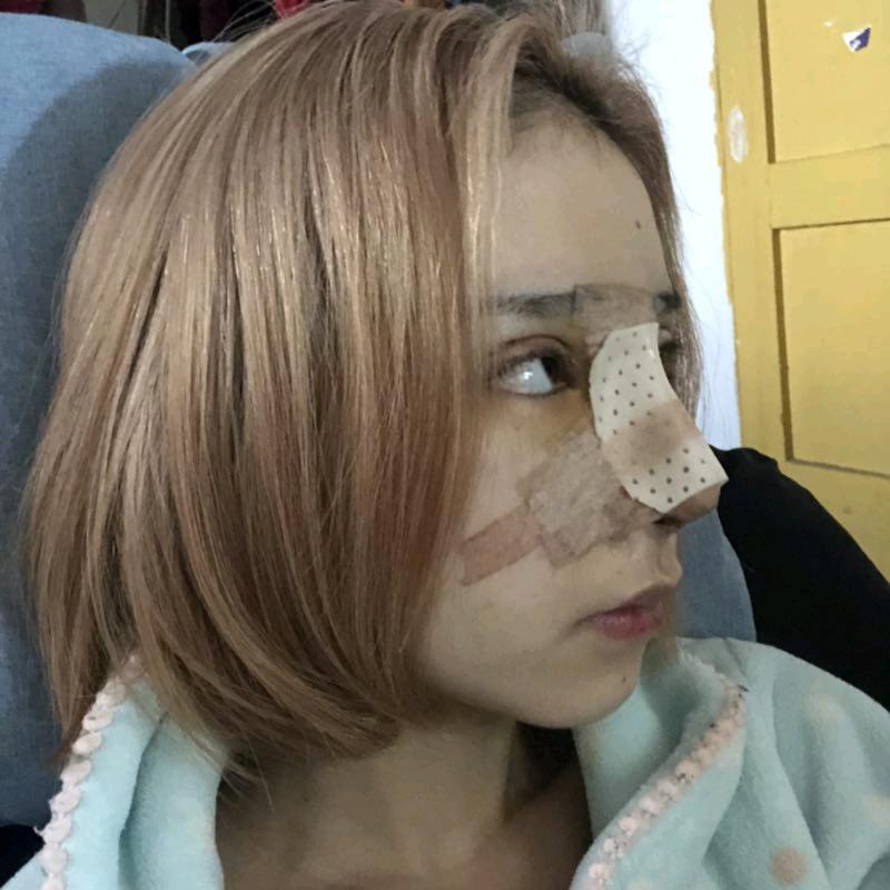 重庆新瑞俪医疗美容医生李光强隆鼻介绍分享！