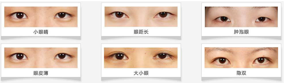 一个单眼皮一个双眼皮,是做一只还是两只眼睛