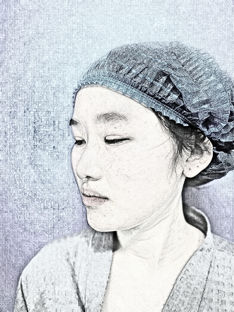 北京蜜邦医疗美容肋软骨隆鼻介绍分享！