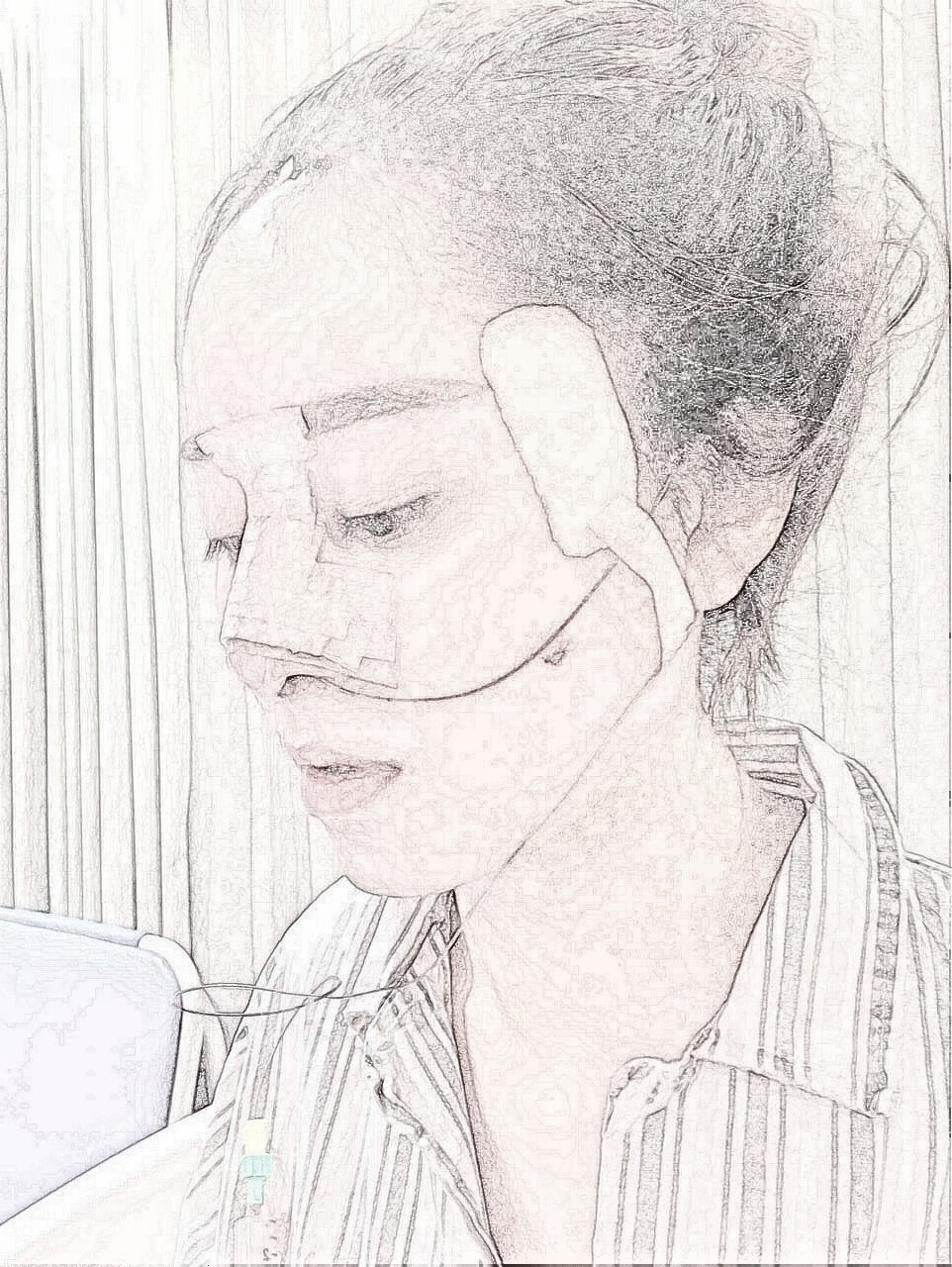 四川美莱医学美容医院肋软骨隆鼻介绍分享！