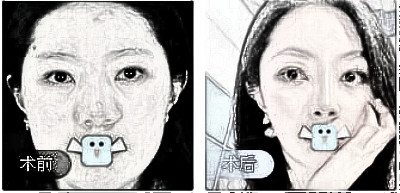 成都医大医生虞冬梅鼻部手术术后分享附图!
