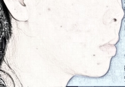 痘痘痕迹怎么办?广州小姐姐祛痘分享附