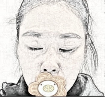 南方医科大学珠江医院医生张贤期隆鼻介绍分享。
