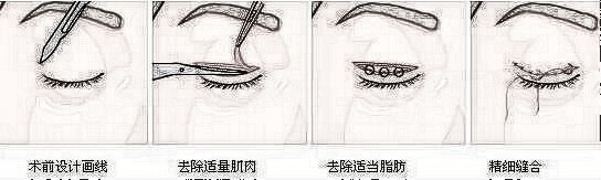 双眼皮手术多方面解析价格及恢复时间