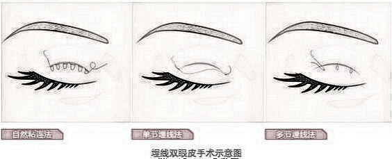 双眼皮手术多方面解析价格及恢复时间