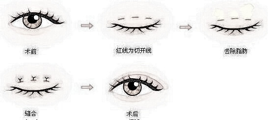 双眼皮手术多方面解析价格及恢复时间