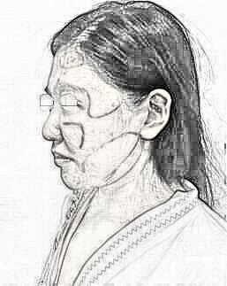 脸部轮廓面部吸脂果如何?多少钱?