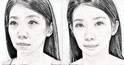 上海仁爱医院拉皮除皱价格是多少？