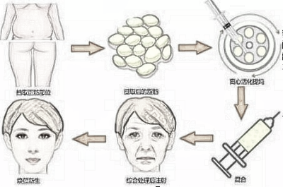 什么样的脸型和状态适合做自脂填充?