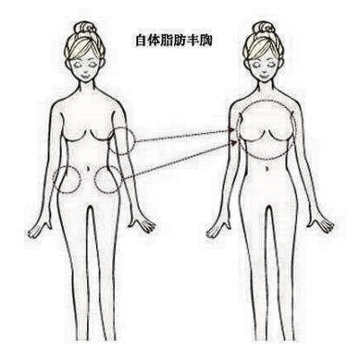 什么样的脸型和状态适合做自脂填充?