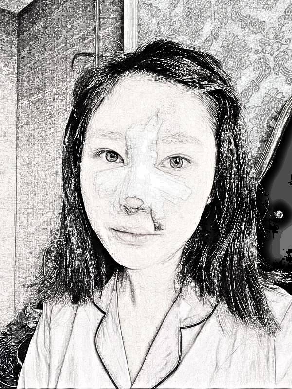 武汉希思特医疗美容医生杨权明隆鼻介绍分享！