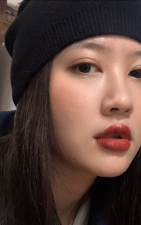 上海百d丽医疗美容医生周珍艳切开双眼皮介绍分享!