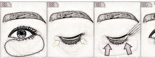 眼袋的出现和形成