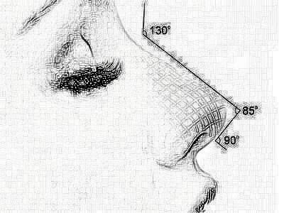 隆鼻常见的四种方式