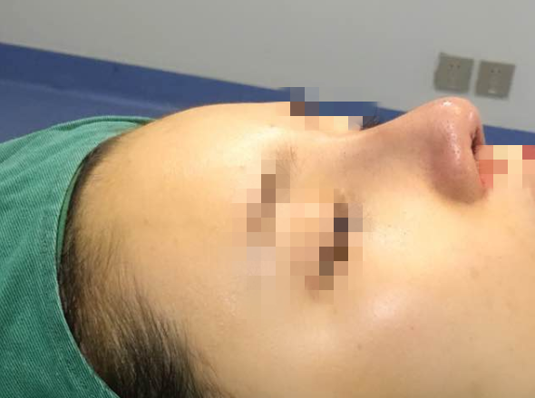 成都仪美美仁医疗美容鼻修复300天术后分享!