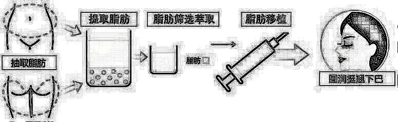 影响自体面部填充费用的差异因素