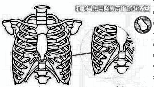 --肋软骨隆鼻常见问题解答