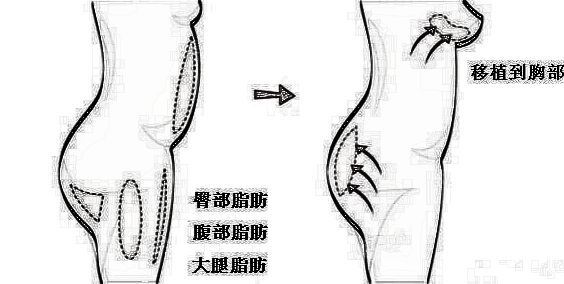 隆胸的方式你都清楚吗?