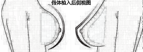 隆胸的方式你都清楚吗?