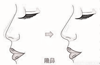 别人隆鼻后果很好,自己去做总觉得有点怪?