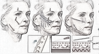 年轻化的埋线提升术手术过程是怎样的呢？