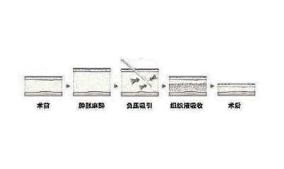 【自体脂肪隆鼻】怎么样？果能持续多久？