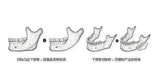 改良下颌角的方式有哪些？