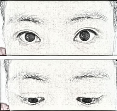 武汉全切双眼皮介绍