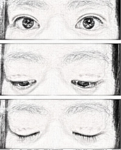 武汉全切双眼皮介绍
