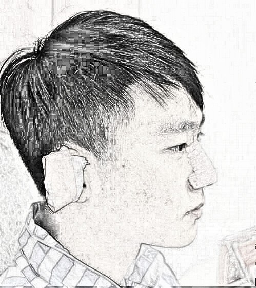 武汉假体隆鼻+耳软骨介绍，果真不错！