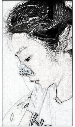 上海隆鼻修复介绍