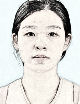 济南全切双眼皮+开内眼角介绍