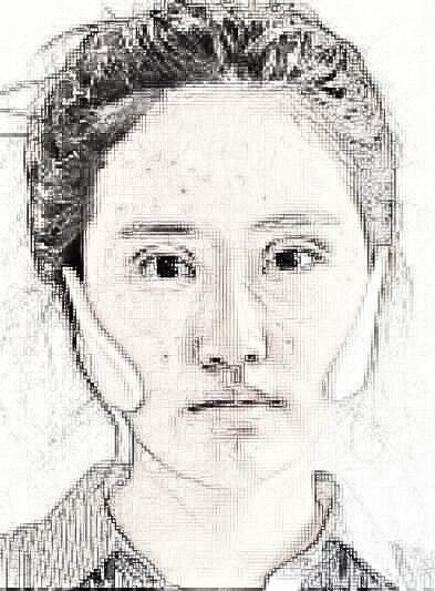 杭州自体脂肪面部填充介绍