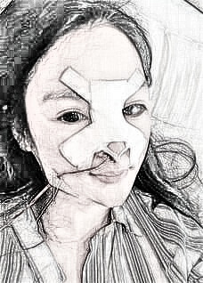成都求美者鼻部手术隆鼻介绍分享