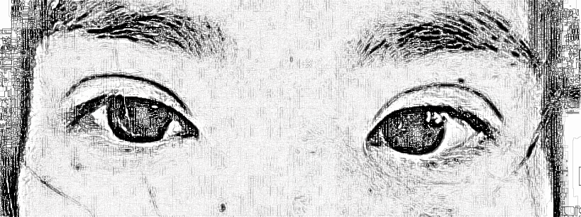 南京华美王小林做的双眼皮开眼角二十多天果。