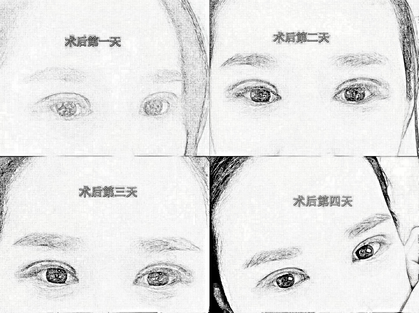 河北邯郸双眼皮隆鼻哪些医生做的好，介绍