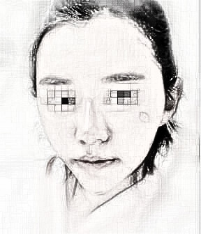 做了全脸脂肪填充,很值得的果