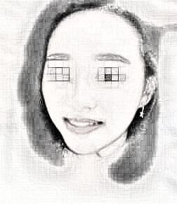 做了全脸脂肪填充,很值得的果