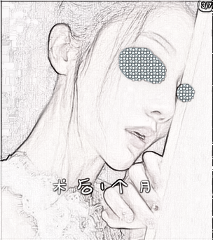 肋软骨隆鼻部手术修复手术,一年了终于变好看