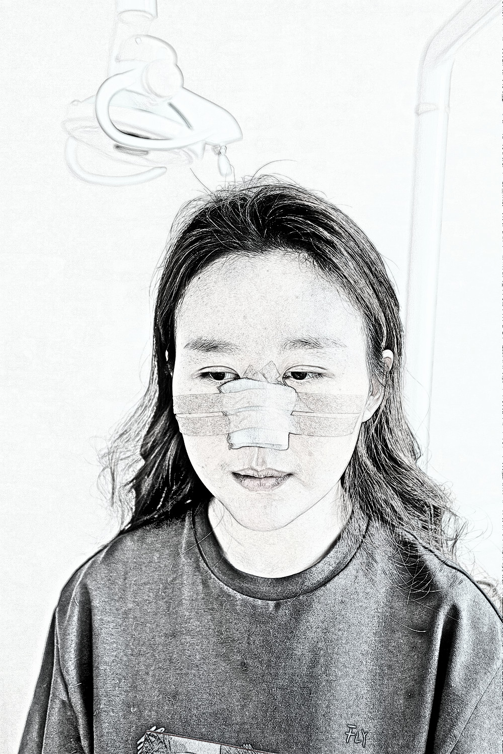 沈阳杏林整形外科医生朱石江膨体隆鼻介绍