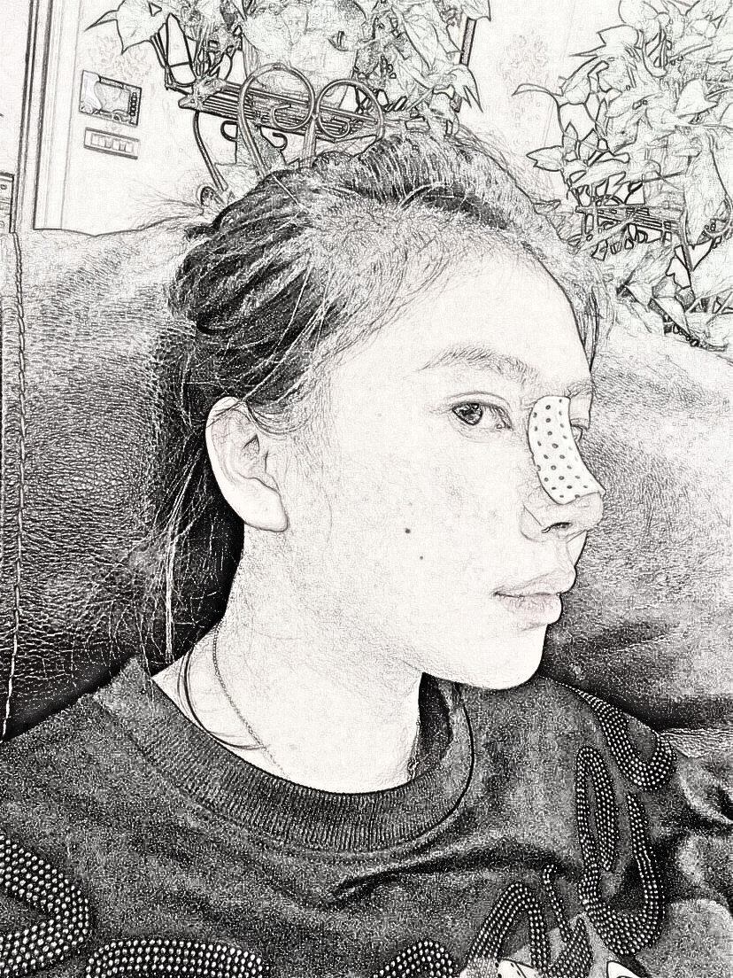 肋软骨隆鼻果怎么样？俊泰丽格医疗美容介绍