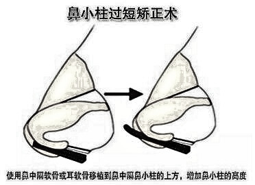 北海华美整形医院鼻小柱延长手术的优势有哪些 甩掉猪鼻子