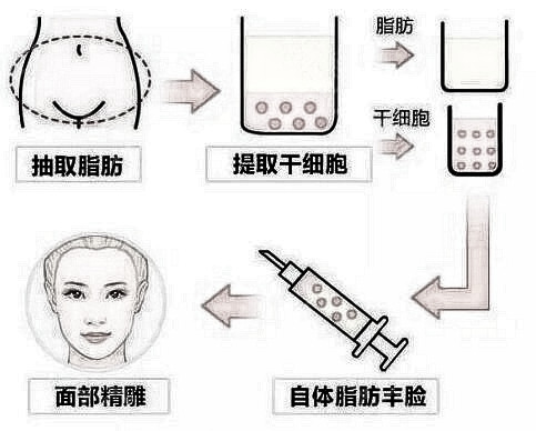 填充面部对量有要求 注射正确年轻20岁