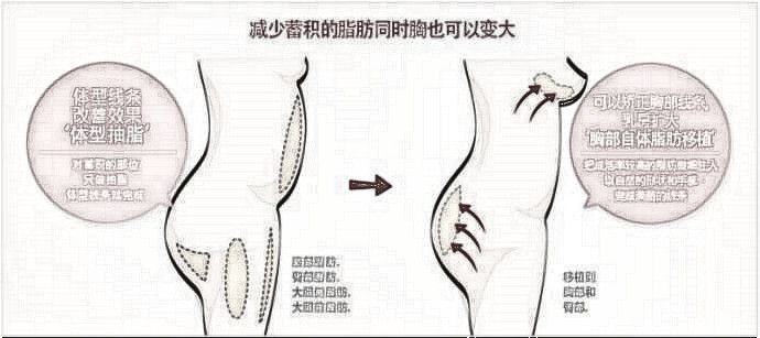 自体脂肪丰胸,自然挺拔,宛若天生