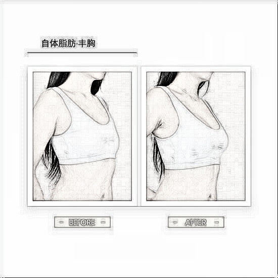 自体脂肪丰胸,自然挺拔,宛若天生