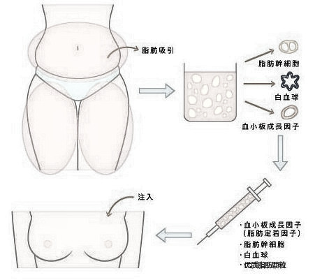 自体脂肪隆胸的好处与危害
