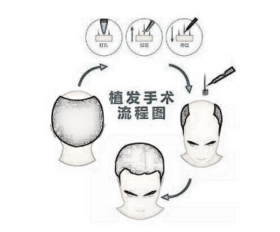 女性脱发怎么办 昆明新生植发专家为您支招